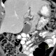 Enteric cyst of duodenum: CT - Computed tomography